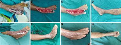 Outcomes of integrated surgical wound treatment mode based on tibial transverse transport for diabetic foot wound